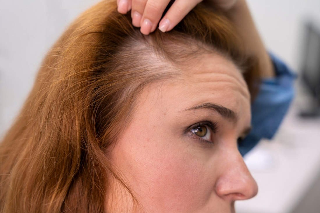 Pelucas y Toppers para Ocultar la Pérdida de Cabello